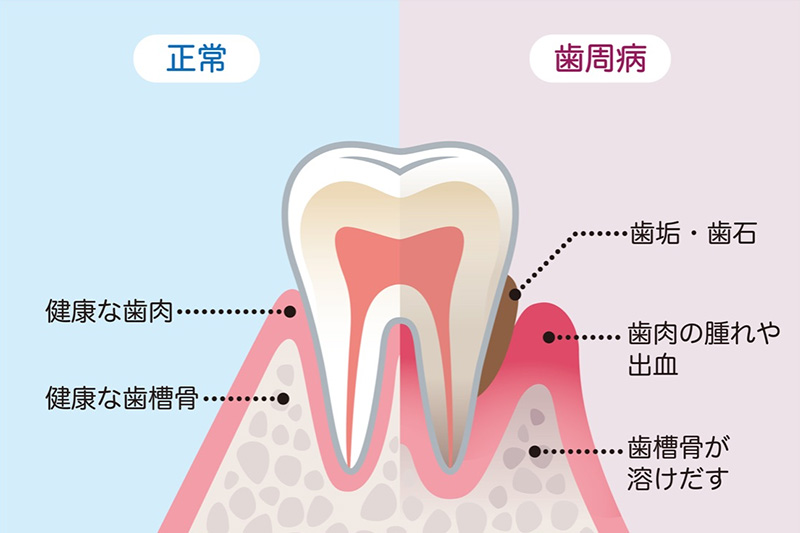 歯周病の治療/歯周病の予防